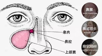苟伟死因揭秘，鼻息肉肥大致呼吸骤停